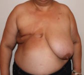 Patient 410 Before Surgey Photo 3 - DIEP Flap Surgery - Breast Cancer Texas