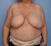 Patient 410 - Surgery 1 Photo 3 - DIEP Flap Surgery - Breast Cancer Texas