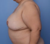 Patient 410 - 3D Tattoo Photo 1 - DIEP Flap Surgery - Breast Cancer Texas