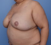 Patient 410 - 3D Tattoo Photo 2 - DIEP Flap Surgery - Breast Cancer Texas