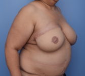Patient 410 - 3D Tattoo Photo 4 - DIEP Flap Surgery - Breast Cancer Texas