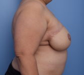 Patient 410 - 3D Tattoo Photo 5 - DIEP Flap Surgery - Breast Cancer Texas