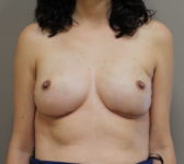 Patient 301 After Overview - Tissue Expander Implant - Breast Cancer Texas