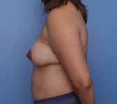 Patient 13 Before Surgey Photo 1 - Nipple Sparing Mastectomy - Breast Cancer Texas