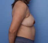 Patient 13 Before Surgey Photo 5 - Nipple Sparing Mastectomy - Breast Cancer Texas