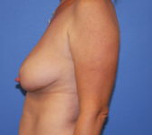 Patient 56 Before Surgey Photo 1 - Mastopexy Breast Reduction Lumpectomy Breast Reduction-Lift - Breast Cancer Texas