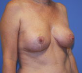 Patient 56 - Surgery 1 Photo 4 - Mastopexy Breast Reduction Lumpectomy Breast Reduction-Lift - Breast Cancer Texas