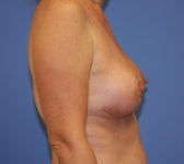 Patient 56 - Surgery 1 Photo 5 - Mastopexy Breast Reduction Lumpectomy Breast Reduction-Lift - Breast Cancer Texas