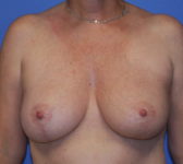 Patient 56 - Surgery 2 Photo 3 - Mastopexy Breast Reduction Lumpectomy Breast Reduction-Lift - Breast Cancer Texas