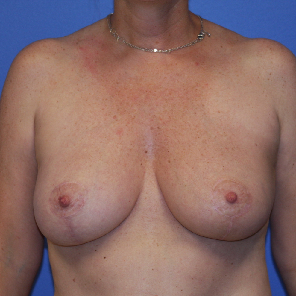 Patient 56 After - Breast Cancer Texas