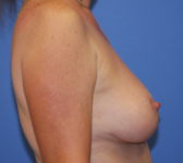 Patient 56 - Surgery 2 Photo 5 - Mastopexy Breast Reduction Lumpectomy Breast Reduction-Lift - Breast Cancer Texas