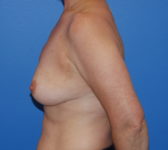 Patient 697 - Surgery 1 Photo 1 - Tissue Expander Implant DIEP Flap Surgery - Breast Cancer Texas