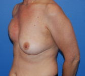 Patient 697 - Surgery 1 Photo 2 - Tissue Expander Implant DIEP Flap Surgery - Breast Cancer Texas
