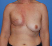 Patient 697 - Surgery 1 Photo 3 - Tissue Expander Implant DIEP Flap Surgery - Breast Cancer Texas