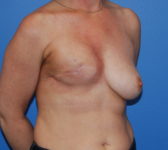 Patient 697 - Surgery 1 Photo 4 - Tissue Expander Implant DIEP Flap Surgery - Breast Cancer Texas