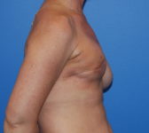 Patient 697 - Surgery 1 Photo 5 - Tissue Expander Implant DIEP Flap Surgery - Breast Cancer Texas