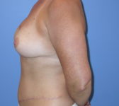 Patient 697 - Surgery 2 Photo 1 - Tissue Expander Implant DIEP Flap Surgery - Breast Cancer Texas