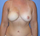 Patient 697 - Surgery 2 Photo 3 - Tissue Expander Implant DIEP Flap Surgery - Breast Cancer Texas