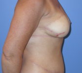 Patient 697 - Surgery 2 Photo 5 - Tissue Expander Implant DIEP Flap Surgery - Breast Cancer Texas