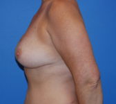 Patient 697 - Surgery 3 Photo 1 - Tissue Expander Implant DIEP Flap Surgery - Breast Cancer Texas