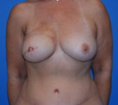 Patient 697 - Surgery 3 Photo 3 - Tissue Expander Implant DIEP Flap Surgery - Breast Cancer Texas