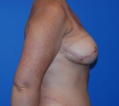 Patient 697 - Surgery 3 Photo 5 - Tissue Expander Implant DIEP Flap Surgery - Breast Cancer Texas