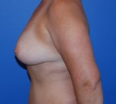 Patient 697 - Surgery 4 Photo 1 - Tissue Expander Implant DIEP Flap Surgery - Breast Cancer Texas