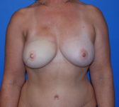 Patient 697 - Surgery 4 Photo 3 - Tissue Expander Implant DIEP Flap Surgery - Breast Cancer Texas