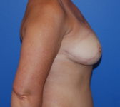 Patient 697 - Surgery 4 Photo 5 - Tissue Expander Implant DIEP Flap Surgery - Breast Cancer Texas