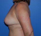 Patient 697 - Surgery 5 Photo 1 - Tissue Expander Implant DIEP Flap Surgery - Breast Cancer Texas