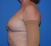 Patient 128 Before Surgey Photo 1 - Tissue Expander Implant Latissimus Muscle - Breast Cancer Texas