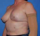 Patient 128 Before Surgey Photo 2 - Tissue Expander Implant Latissimus Muscle - Breast Cancer Texas
