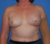 Patient 128 Before Surgey Photo 3 - Tissue Expander Implant Latissimus Muscle - Breast Cancer Texas