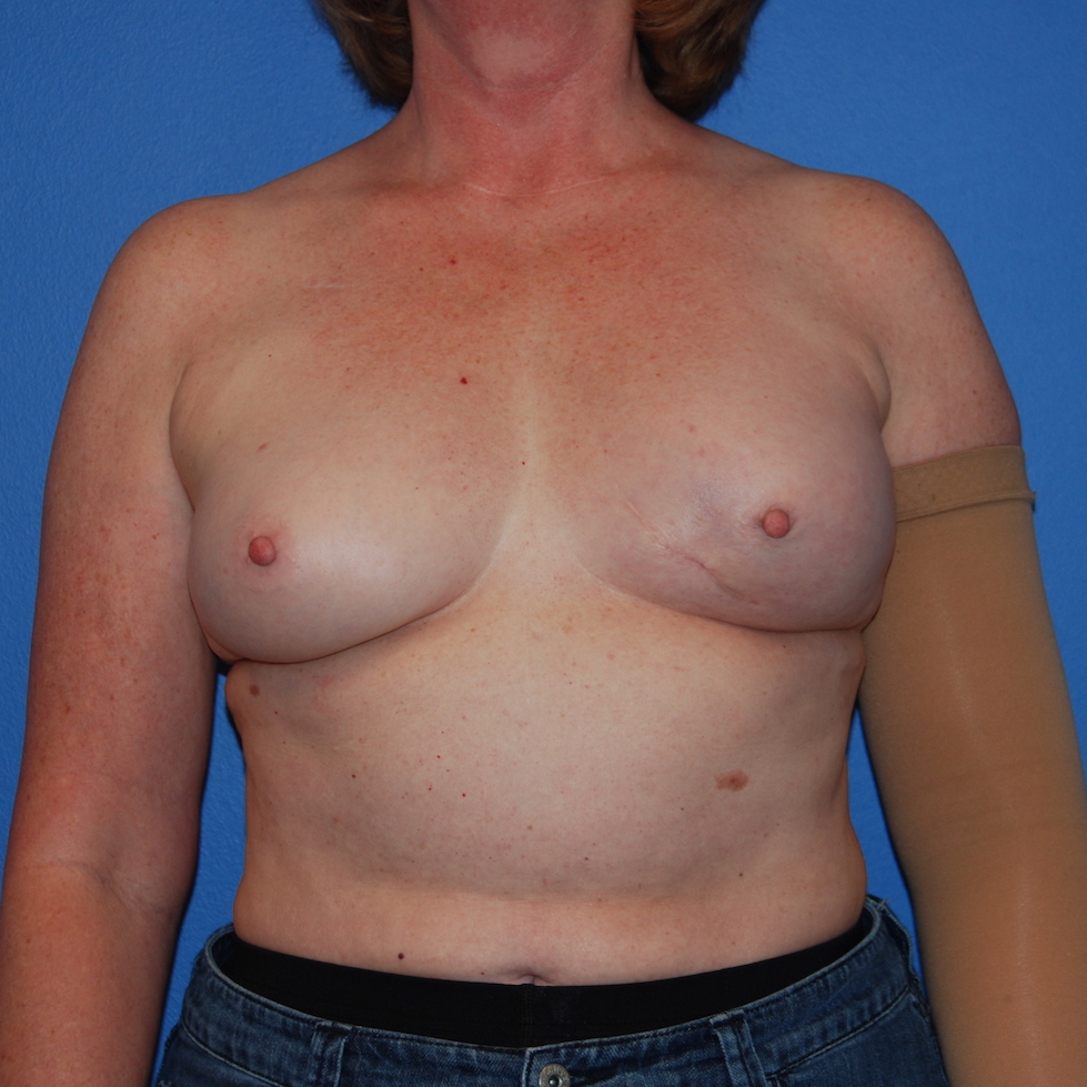Patient 128 Before Overview - Tissue Expander Implant Latissimus Muscle - Breast Cancer Texas