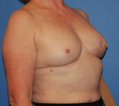 Patient 128 Before Surgey Photo 4 - Tissue Expander Implant Latissimus Muscle - Breast Cancer Texas