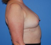 Patient 128 Before Surgey Photo 5 - Tissue Expander Implant Latissimus Muscle - Breast Cancer Texas