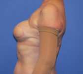 Patient 128 - Surgery 1 Photo 1 - Tissue Expander Implant Latissimus Muscle - Breast Cancer Texas