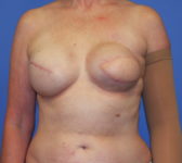 Patient 128 - Surgery 1 Photo 3 - Tissue Expander Implant Latissimus Muscle - Breast Cancer Texas