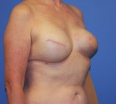 Patient 128 - Surgery 1 Photo 4 - Tissue Expander Implant Latissimus Muscle - Breast Cancer Texas