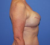 Patient 128 - Surgery 1 Photo 5 - Tissue Expander Implant Latissimus Muscle - Breast Cancer Texas