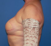 Patient 128 - Surgery 2 Photo 1 - Tissue Expander Implant Latissimus Muscle - Breast Cancer Texas