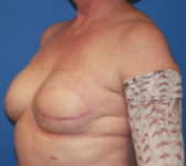 Patient 128 - Surgery 2 Photo 2 - Tissue Expander Implant Latissimus Muscle - Breast Cancer Texas