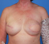 Patient 128 - Surgery 2 Photo 3 - Tissue Expander Implant Latissimus Muscle - Breast Cancer Texas