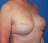 Patient 128 - Surgery 2 Photo 4 - Tissue Expander Implant Latissimus Muscle - Breast Cancer Texas