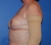 Patient 128 - Surgery 3 Photo 1 - Tissue Expander Implant Latissimus Muscle - Breast Cancer Texas