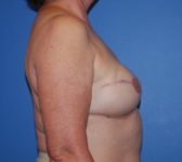 Patient 128 - Surgery 3 Photo 5 - Tissue Expander Implant Latissimus Muscle - Breast Cancer Texas