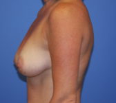 Patient 561 Before Surgey Photo 1 - Tissue Expander Implant - Breast Cancer Texas