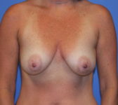 Patient 561 Before Surgey Photo 3 - Tissue Expander Implant - Breast Cancer Texas