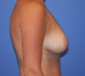 Patient 561 Before Surgey Photo 5 - Tissue Expander Implant - Breast Cancer Texas