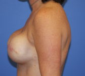 Patient 561 - Surgery 1 Photo 1 - Tissue Expander Implant - Breast Cancer Texas